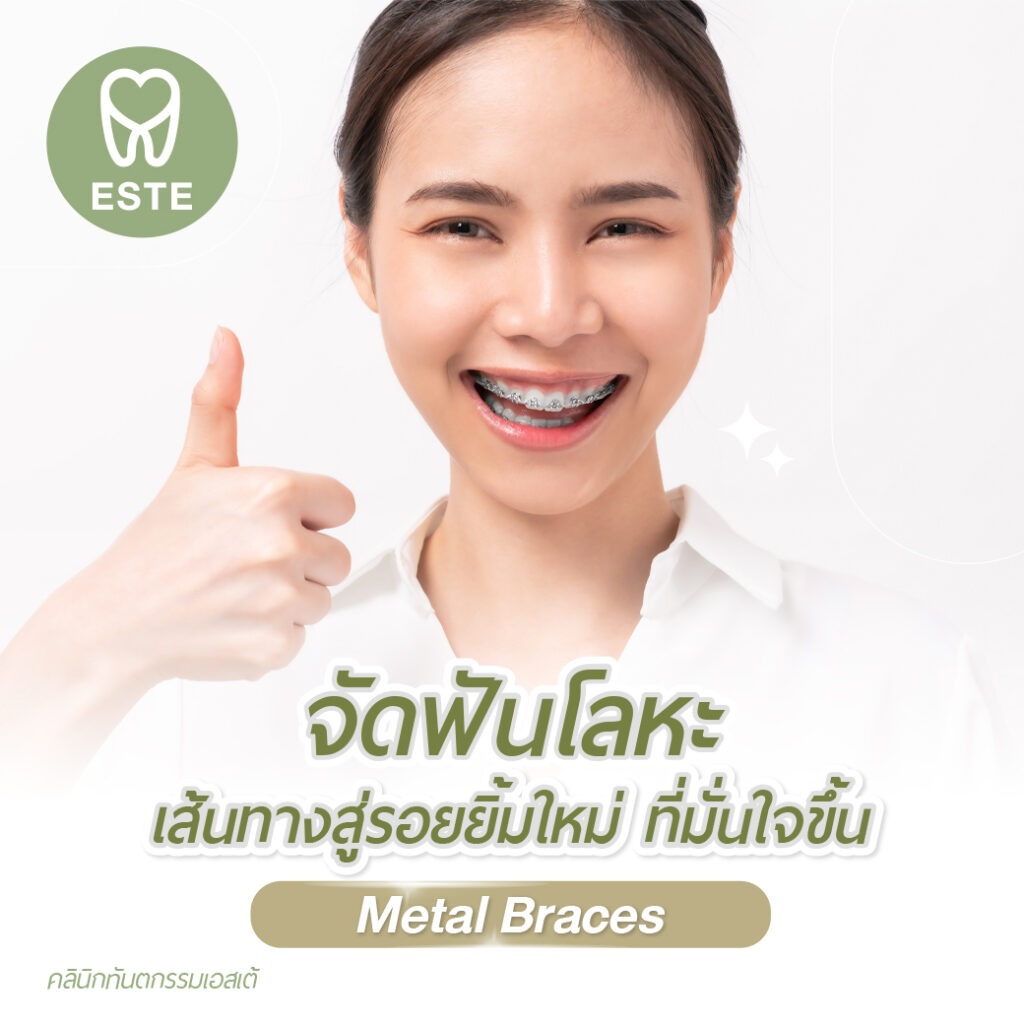 จัดฟันโลหะ