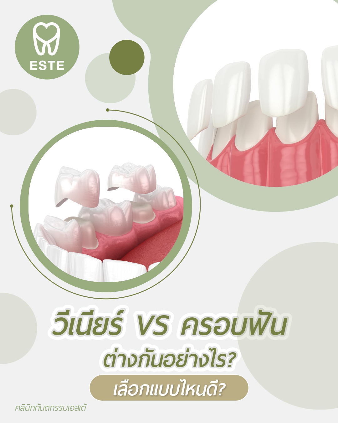 veneers-vs-crowns