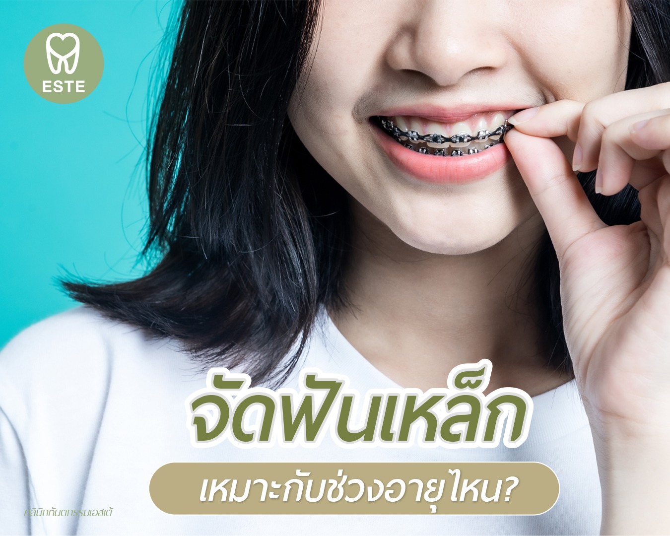 braces-age