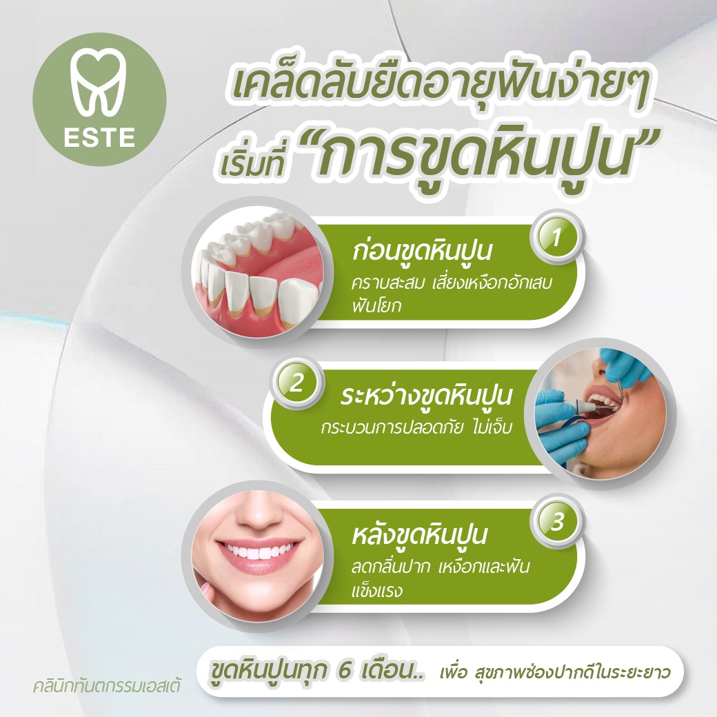 ขูดหินปูน