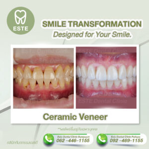 Smile Transformation Designed For Your Smile